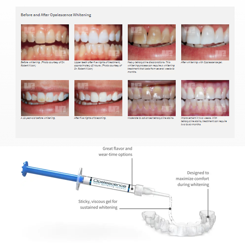Opalescence Whitening 20% PF 2 – Teeth Whitening In Office recenzja i cena