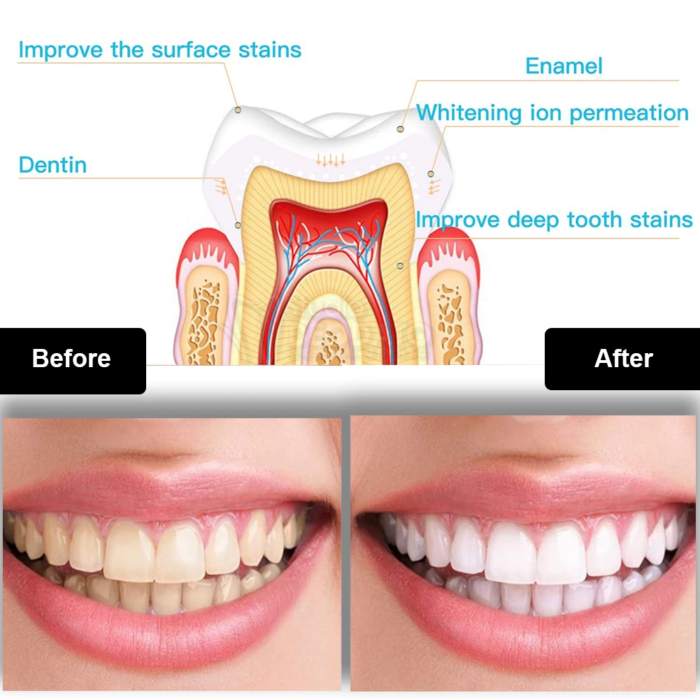 Zestaw do wybielania zębów den – Teeth Whitening Q&M recenzja i cena